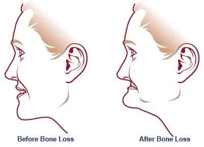 Before and after bone loss