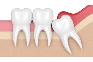 Wisdom teeth animation